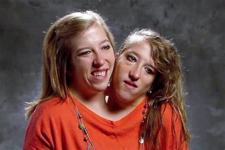 Abby and Brittany Hensel Sad News: A Journey of Resilience
