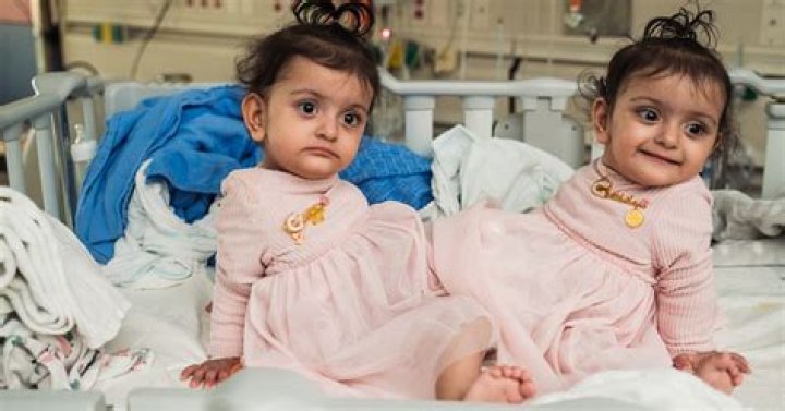 Conjoined Twins Tatiana and Krista: An Inspiring Journey in 2024
