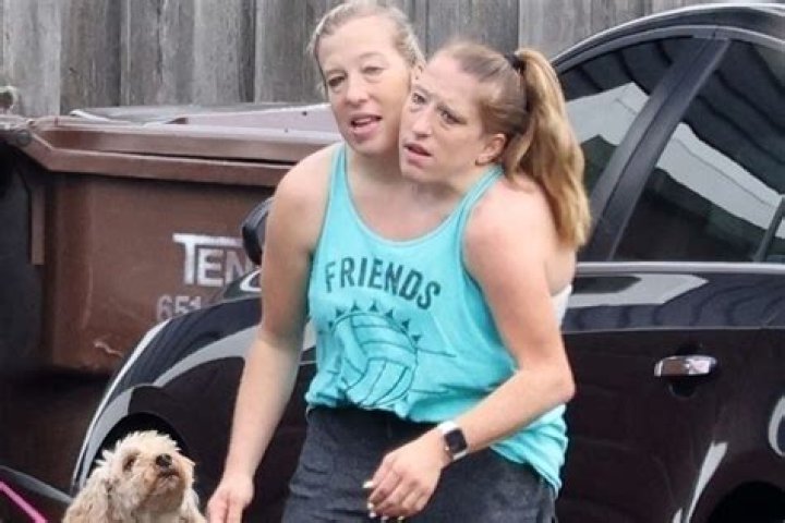 Hensel Twins Sad News: A Deep Dive into Their Journey and Challenges