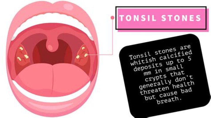 Popping Hidden Tonsil Stones: Understanding, Prevention, and Treatment