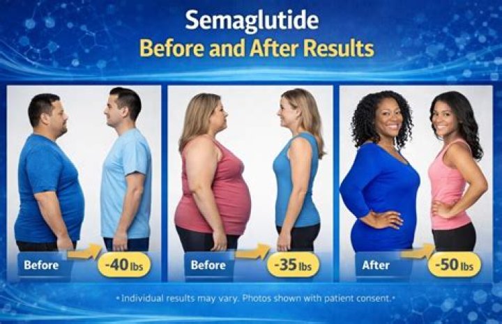 Semaglutide Before and After: A Comprehensive Guide to Weight Loss Success
