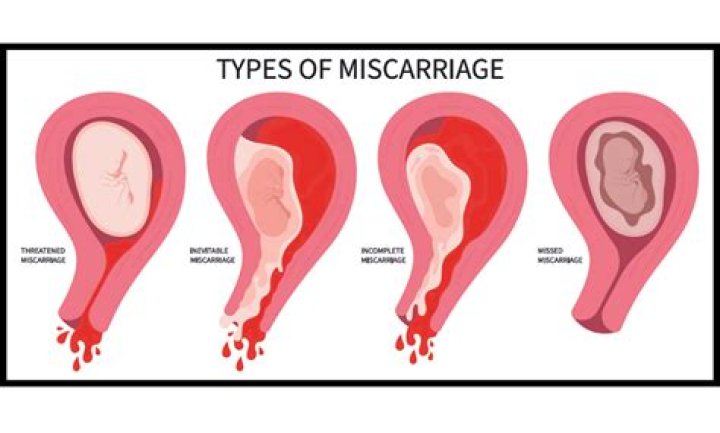 Understanding Miscarriage Clots: Pictures, Causes, and What to Expect