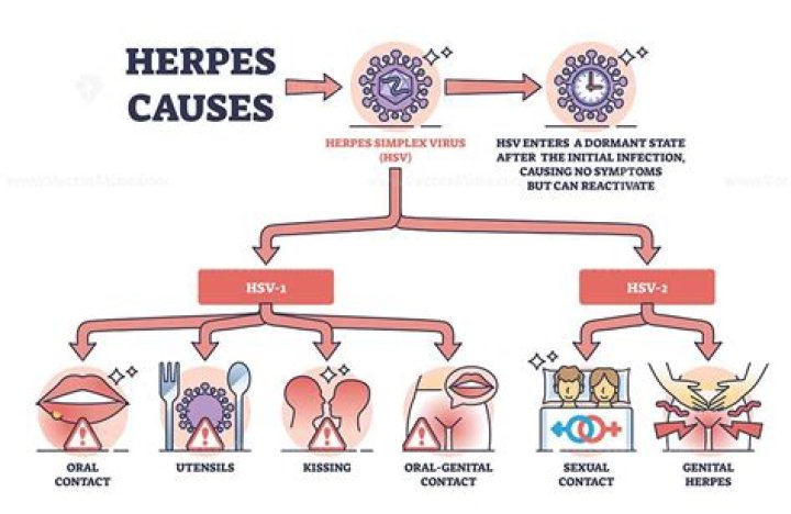 Usher and Herpes: Understanding the Facts and Implications